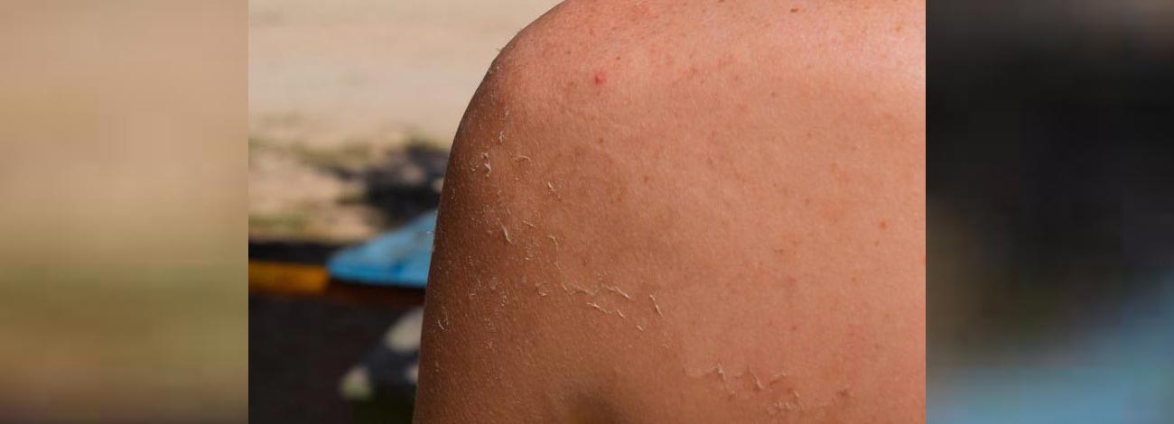 Ist eine Rotlichttherapie gut gegen Sonnenbrand?